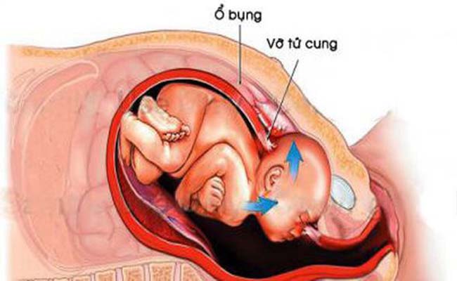 Khó tin: Sản phụ  9X đột nhiên bị 'nổ' tử cung khi đang mang thai 37 tuần 